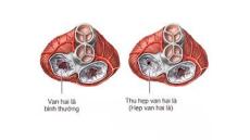 Tư vấn: Liệu pháp hiệu quả cho bệnh hẹp van hai lá